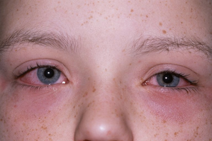 Watery eyes from food allergies
