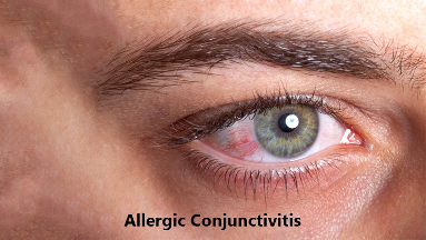 Allergic Conjunctivitis Eye Irritation