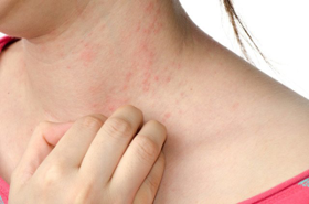 Contact Dermatitis Skin Irritation