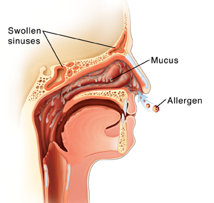 Nasal Irritation